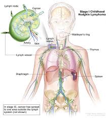Swollen lymph nodes usually indicate a temporary infection, but they can also be a sign of some medical conditions, including certain immune disorders and types of cancer. Recovery From Acute Leukemia Gives Teacher Something To Celebrate Uams Winthrop P Rockefeller Cancer Institute