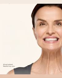 Botox Cosmetic injections help soften the platismal bands (neck bands)  helping the neck look smoother and contribute to jawline rejuvenation.  Combine with Radiesse to soften horizontal lines
