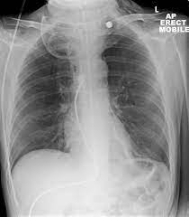 Why does the back of my throat feel swollen? Laryngeal Tumor Squamous Cell Carcinoma Radiology Case Radiopaedia Org