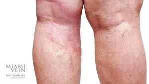 Image result for Lipodermatosclerosis