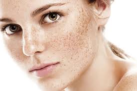 Image result for Freckles
