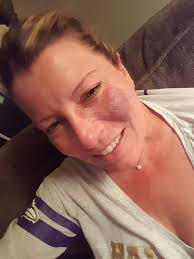 Since I had so many comment about my "hairy belly" saying that I need to  shave my stomach, I figured I would fill you all in. I had surgery two  years ago