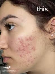 Essential Morning Skincare Routine for Accutane Users