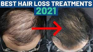 So, your hairline is changing and you are seeing more of your scalp than you would like. Best Hair Loss Treatments Ranked Fin Min Prp Youtube