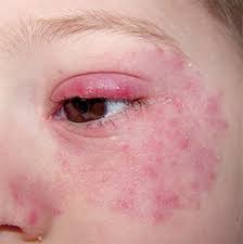 New Health Guide For Your Everyday Health Eczema Around Eyes Eczema Treatment Dry Skin Around Eyes