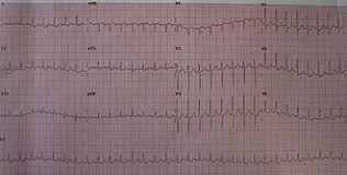 Supraventrik?ler ta?ikardi (svt) ritim bozukluklar?n?n en s?k g?r?len nedenlerindendir. Supraventricular Tachycardia Wikipedia