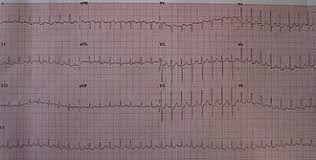 This was svt's first logo. Supraventricular Tachycardia Wikipedia