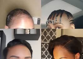 Hair growth has three stages. African Women On The Shame Of Hair Loss Bbc News