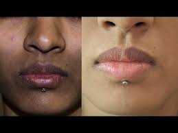 How can i get rid of dark patches on my face? How To Remove Dark Spots Black Patches Hyper Pigmentation Around Mouth Superwowstyle Prachi Youtube