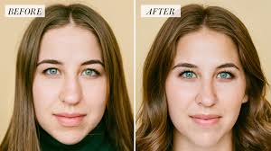 Everything you need to know. My Rhinoplasty Procedure Story Nose Before And After Photos Allure