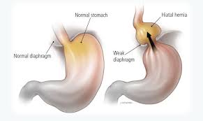Image result for stomach hernia symptoms