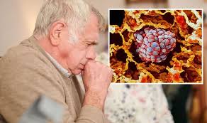 Lung cancer is one of the most common and serious types of cancer, with around 47,000 diagnoses in the uk each year. Lung Cancer Symptoms Signs Include Bronchitis Express Co Uk