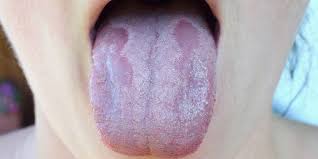 If so, how? answered by dr. White Tongue Causes Symptoms And Treatment
