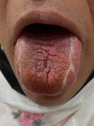 Image result for Fissured tongue