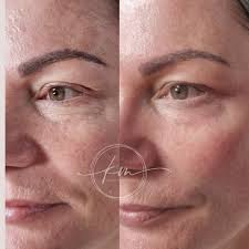 ✨Reduce wrinkles & lift & tighten loose skin now for less!✨ FOR THE MONTH  OF MAY, PAY FOR 1 AREA GET 2 AREAS TREATED! With the incredible Plasma Pen  Fibroblast Skin Tightening