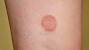 Red Spots On Legs Not Itchy