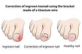 How to soften hard toenails. Ingrown Toenail How To Treat Cut Prevent Ingrown Toenails