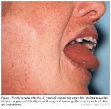Learn the signs of immune reactions to food so you're prepared. Food Allergy Latest Guidelines From The Nih Consultant360