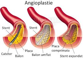 Depistarea si tratamentul pentru retinopatia diabetica. Angioplastia Si Stentul Vascular Proceduri Medicale