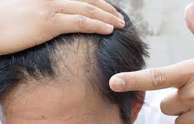 In this section of our site, we provide free hair loss articles to help our visitors understand some of the common reasons for male and female hair loss. Going Bald And Toothaches Here S How They Re Related Ratemds Health News