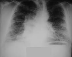 Care sunt simptomele fibrozei pulmonare? Https Pneumologie Usmf Md Sites Default Files Inline Files Indicatii 20metodice 20munteanu 1 Pdf