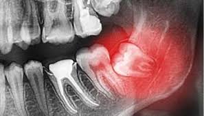 The wisdom teeth usually do not cause any dental problem although there are some individuals who prefer to have their wisdom teeth removed. Wisdom Teeth Removal