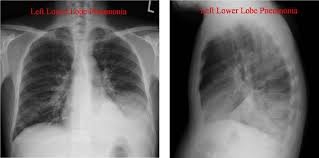 Lung Parenchyma Page 2 Toronto Notes