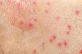 How To Get Rid Of Flea Bites Garden Insect Repellent Good To Know Natural Healing