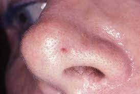 Maybe you would like to learn more about one of these? Cancer Basocellulaire Le Carcinome Basocellulaire Ou Baso Teleconsultation Dermatologue