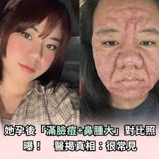 她孕後「滿臉痘+鼻腫大」對比照曝！ 醫揭真相：很常見圖／翻攝自X、IG