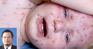 Tanda pasti hamil 1 bulan; Bila Anak Kena Chicken Pox Ikut Nasihat Pemakanan Oleh Doktor Ini Keluarga
