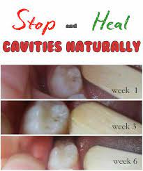 Stop And Heal Cavities Naturally Heal Cavities Teeth Health Health And Nutrition