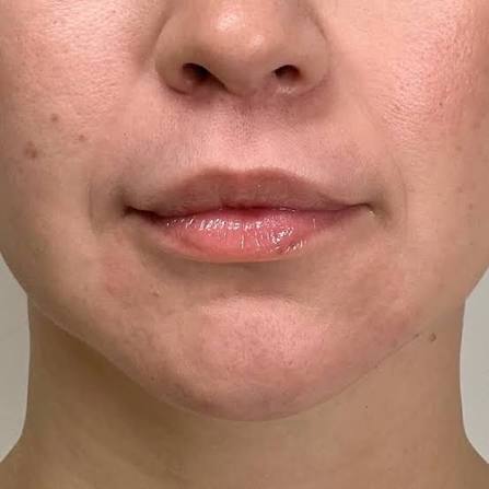 Lip Lift Treatment with Dr Rami Haidar | Maxillofacial | Dubai