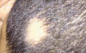 Clay hair benefits are different, depending on the type of a product (colour). Bentonite Clay For Hair Mask For Natural Hair Growth Loss Benefits How To Use Recipes 4c Where To Buy Side Effect