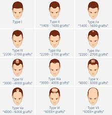 Diagnosing and treating hair loss / anne l. Male Pattern Hair Loss Hair Loss In Men