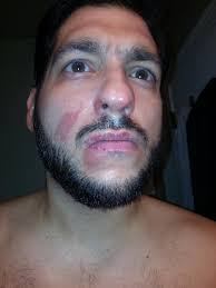 97.1 FM's Mike Valenti suffers facial burn at Metro Detroit restaurant