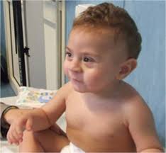 The boy at the age of 1 year. Note low set ears, epicanthus and thin...