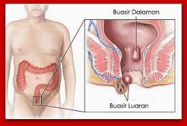 Darah yang keluar warnanya cerah. Bahaya Buasir Obat Tradisional Berak Darah Segar Pokok Ubat Buasir Buasir Ibu Mengandun Ubat Buasir De Natur Ubat Buasir Ubat Buasir Herba