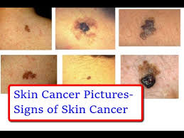 If left untreated, it can become a serious health problem. Skin Cancer Pictures Signs Of Skin Cancer In Pictures Youtube
