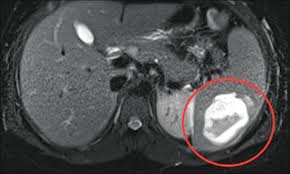 Image result for Splenic Abscess