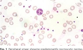 1, 2 erythroblasts are virtually absent in bone marrow; Pdf Carbamazepine Induced Pure Red Cell Aplasia Semantic Scholar