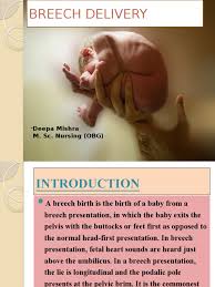 Image result for Breech Delivery