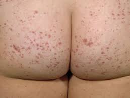 It can evolve to become widespread and often has a chronic course. Henoch Schonlein Purpura Dermnet Nz