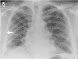 Pleural effusions may result from pleural, parenchymal, or extrapulmonary disease. State Of The Art Radiological Investigation Of Pleural Disease Sciencedirect