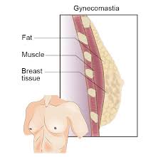 Image result for Gynecomastia