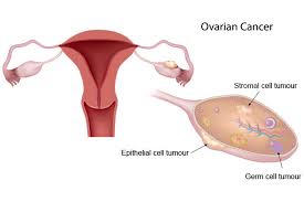 Of all these, ovarian cancer originates deep within the lower abdomen and often goes undetected until it is too late. Ovarian Cancer Cysts Causes Symptoms Mount Elizabeth Hospitals