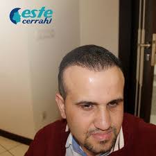Ekim Operasyonundan 5 Ay Sonra Sacekimi Sac Sacsizlik Sacekme Dogalsaclar Naturelsaclar Sackiran Kellik Istanbul Turkey Estecerra Dogal Sac Sac Kina
