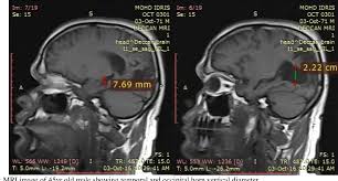 Anatomical Study Of Size Variability Of Temporal And Occipital Horns Of Lateral Ventricles Of Human Brain Mri Study Semantic Scholar