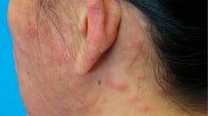 Image result for skin rash acute hiv infection