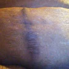 Posted june 1, 2014 medicaid might pay for the partial abdominoplasty, under certain conditions. Will Medicaid Pay For Tummy Tuck Under Medically Necessary Plastic Surgery And Not Cosmetic Photo